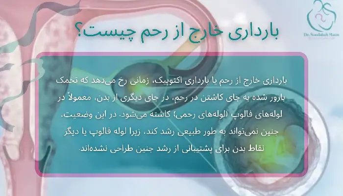 بارداری خارج از رحم