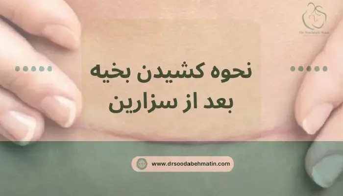 کشیدن بخیه بعد از سزارین
