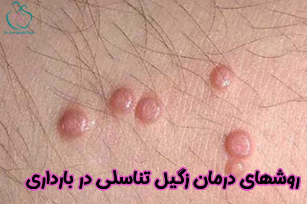 روشهای درمان زگیل تناسلی در بارداری