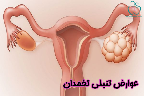 عوارض تنبلی تخمدان