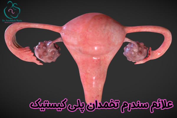 علائم سندرم تخمدان پلی کیستیک