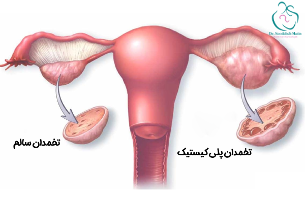 سندرم تخمدان پلی کیستیک چیست