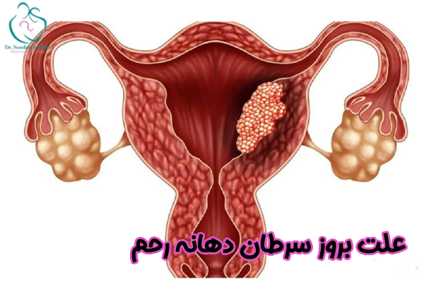 علت بروز سرطان دهانه رحم