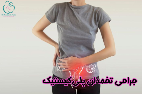 جراحی تخمدان پلی کیستیک