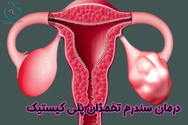 درمان سندرم تخمدان پلی کیستیک چیست