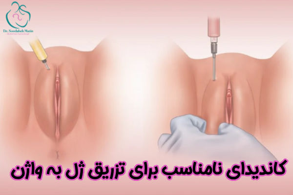 کاندیدای نامناسب برای تزریق ژل به واژن