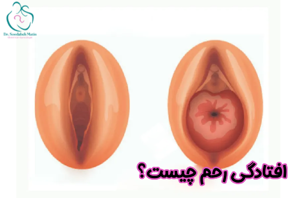 افتادگی رحم چیست
