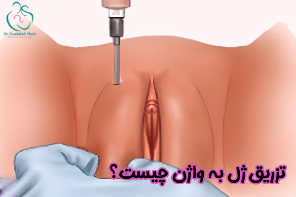 تزریق ژل به واژن چیست