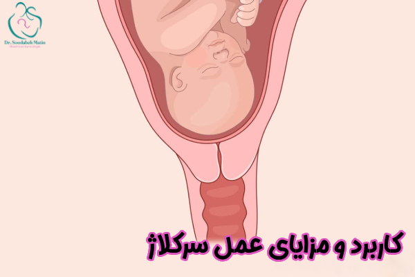 مزایای عمل سرکلاژ